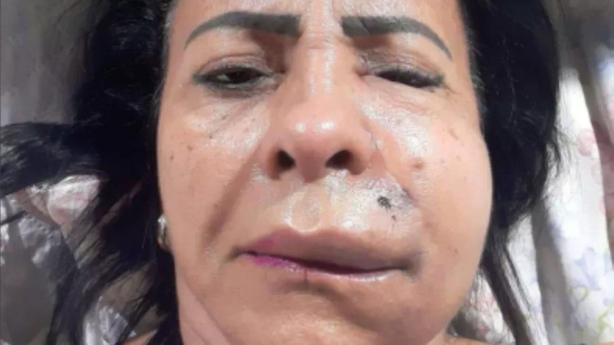Mulher retira 40 nódulos do rosto após harmonização facial; entenda Mulher retira 40 nódulos do rosto após harmonização facial; entenda