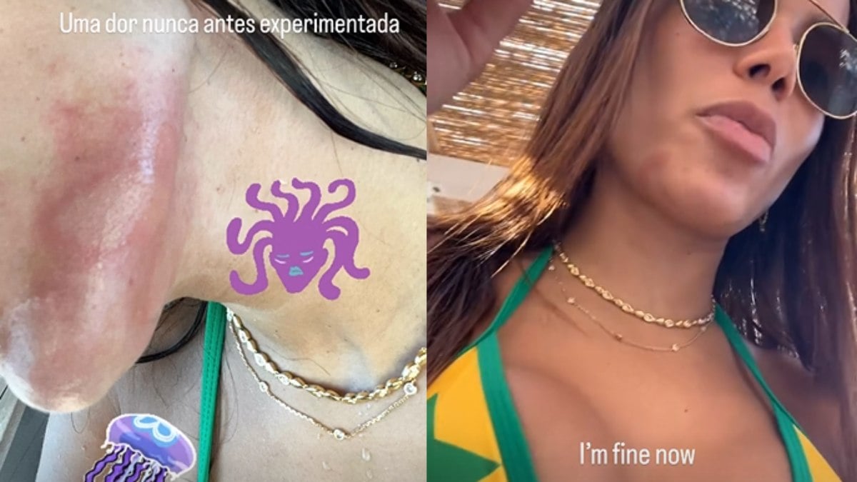Queimadura de água-viva pode matar? Saiba risco que Anitta sofreu ao lutar com uma Queimadura de água-viva pode matar? Saiba risco que Anitta sofreu ao lutar com uma
