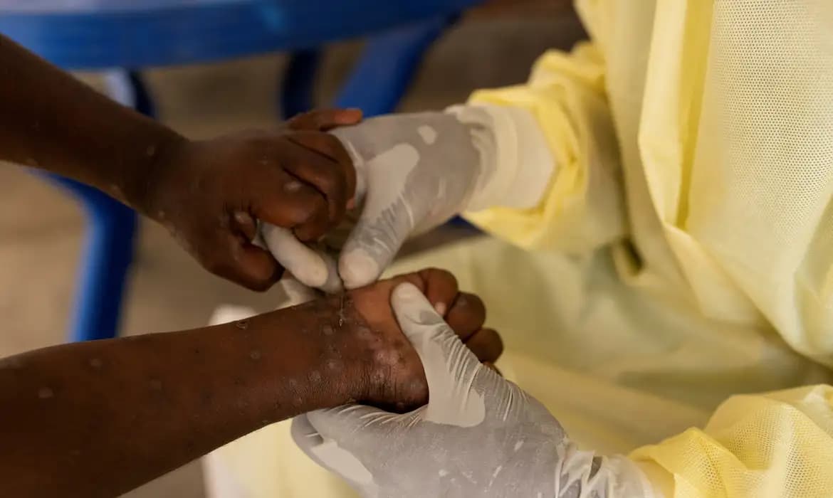 Saúde negocia compra de 25 mil doses de vacina contra mpox – ac24horas.com Saúde negocia compra de 25 mil doses de vacina contra mpox – ac24horas.com