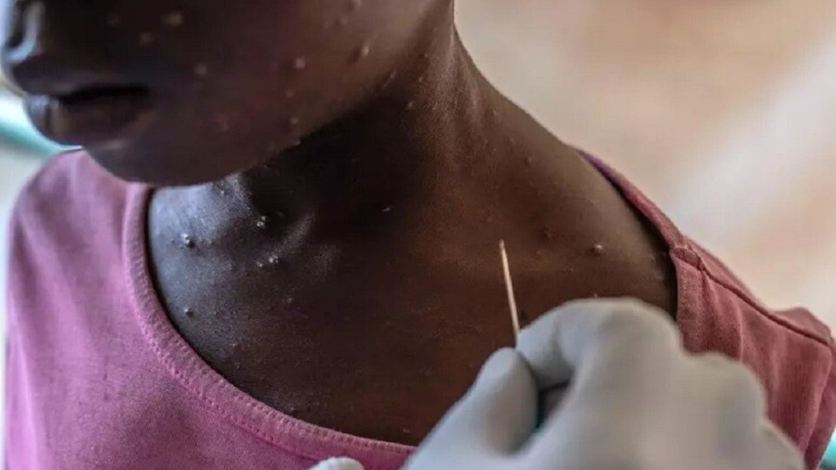 Vacina nacional contra a mpox entra em fase final Vacina nacional contra a mpox entra em fase final