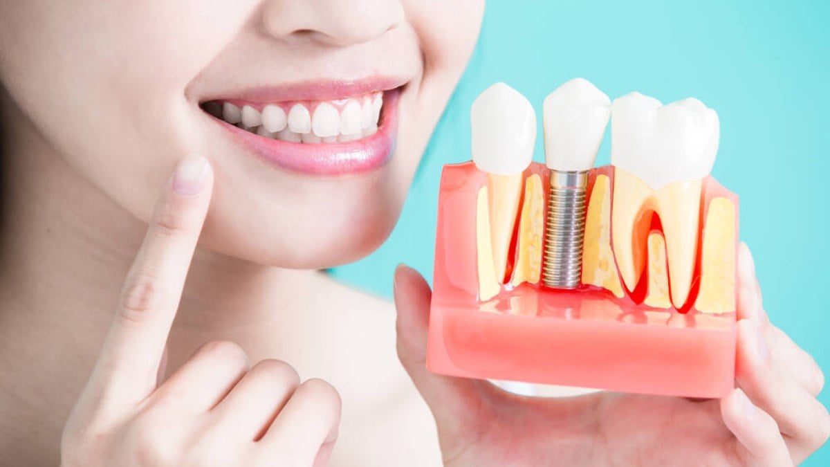 A importância da limpeza nos implantes dentais A importância da limpeza nos implantes dentais
