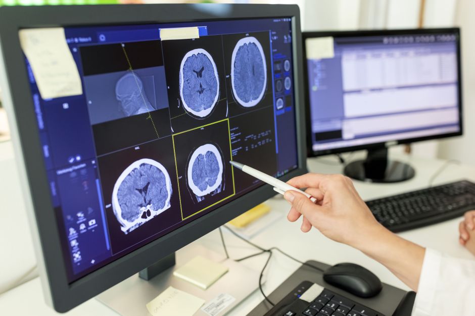 Doenças neurodegenerativas: o que são, sinais de alerta e como diagnosticar Doenças neurodegenerativas: o que são, sinais de alerta e como diagnosticar