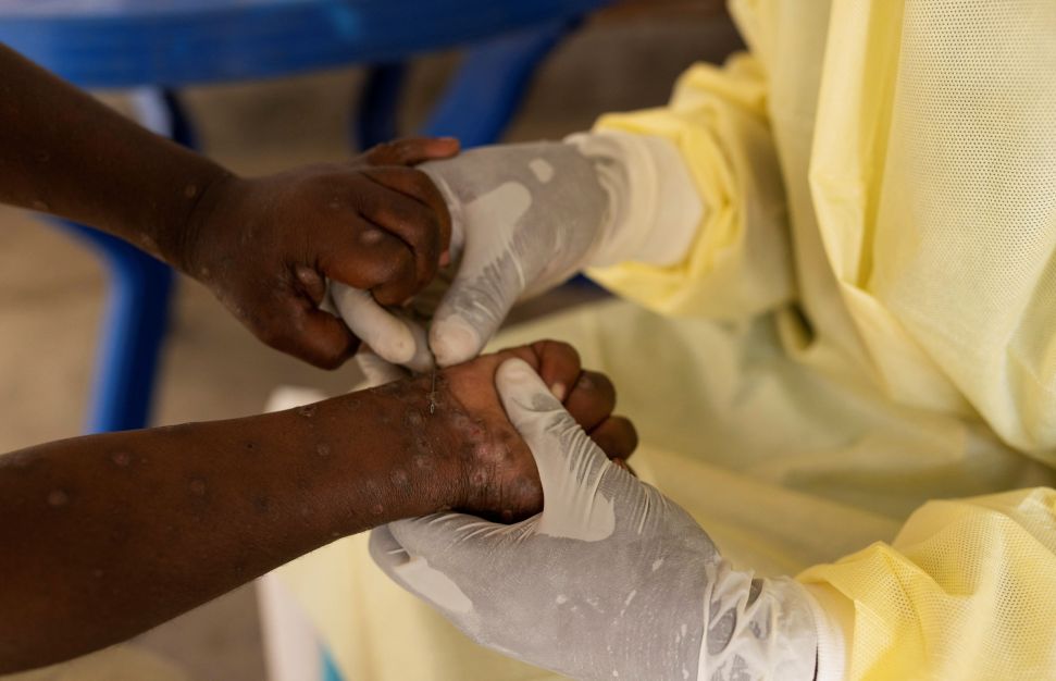 “Mpox não é a nova Covid“, diz diretor da Organização Mundial da Saúde “Mpox não é a nova Covid“, diz diretor da Organização Mundial da Saúde