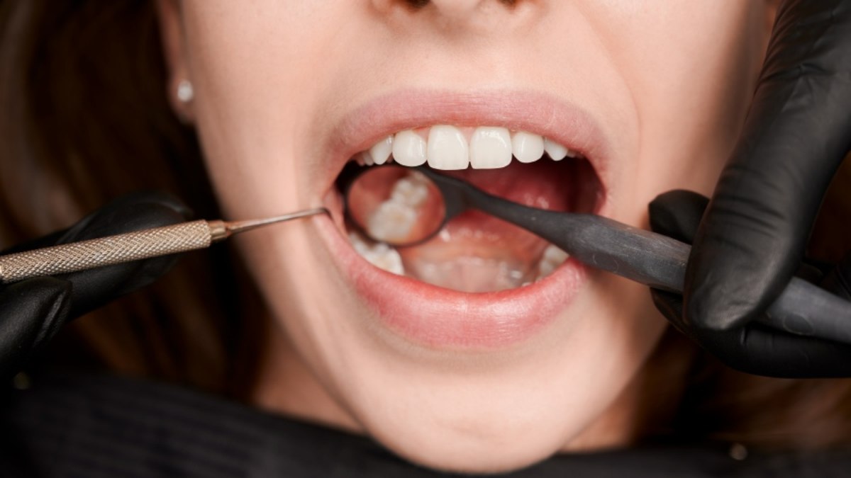 Dente anquilosado: diagnóstico, causas e tratamento Dente anquilosado: diagnóstico, causas e tratamento