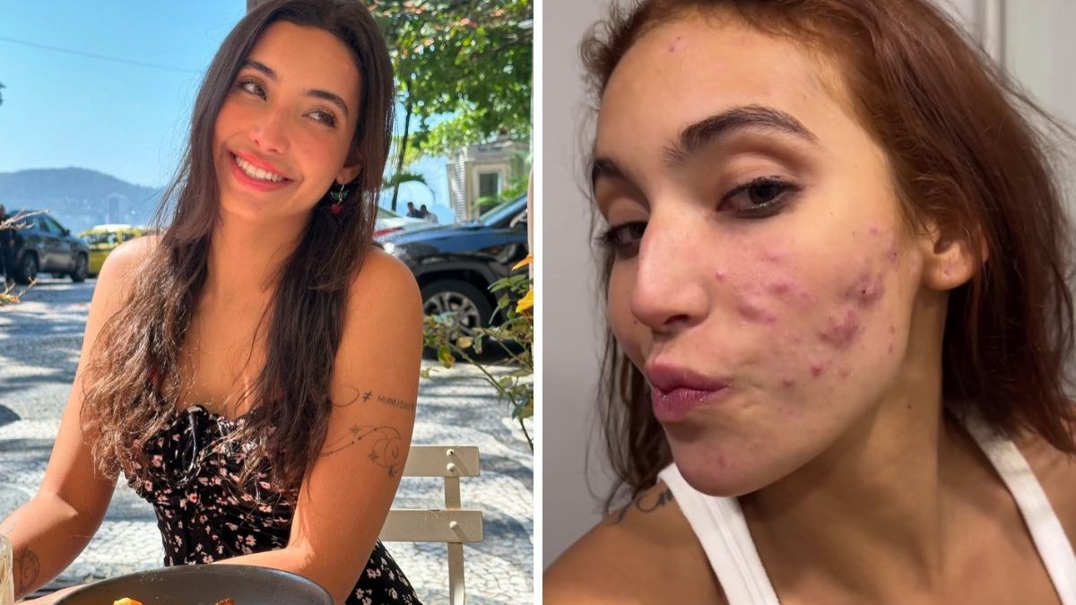 Vanessa Lopes desabafa após um mês de Roacutan: ‘Autoestima está lá embaixo’ Vanessa Lopes desabafa após um mês de Roacutan: ‘Autoestima está lá embaixo’